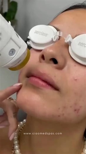 Ciao Med Spa | Did you know Aerolase laser therapy can treat acne? Our NeoClear acne treatment can help: - Reduce acne on the face, back, and chest -... | Instagram