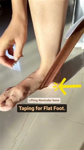 Tapping for flat foot#youtube #shortvideo #physiotherapist #physiotherapytreatment #painrelief #