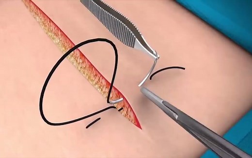 【手术缝合技巧】【垂直褥式缝合】Vertical Mattress Suture | BMJ Learning