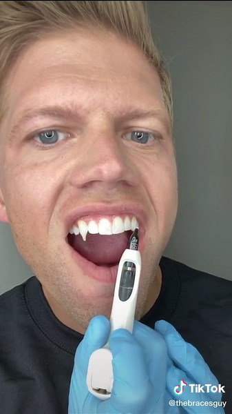 Just making some fangs🩸You’ll see why on my insta tomorrow 👀IG:thebracesguy