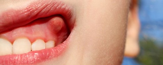 Abcès dentaire : comment le faire disparaître et le traiter ?