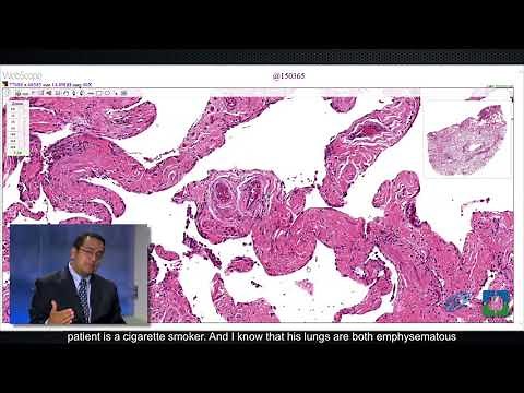 Pathology Insights: Atypical Epithelial Cells with Sanjay Mukhopadhyay, MD