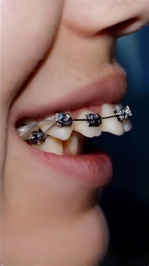 power of Braises | teeth alignment | Braises