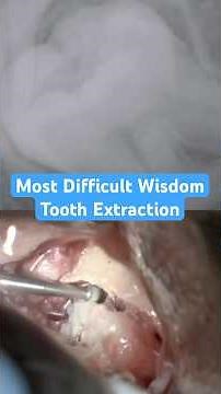 How to Extract an Impacted Wisdom Tooth #dentist #howto #dentistry #wisdomtoothextraction #dental