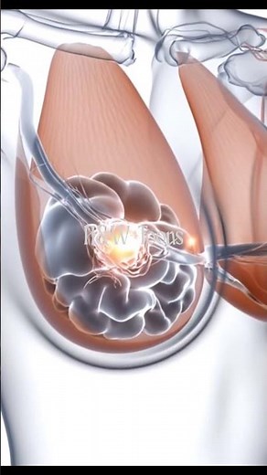 The Mechanics of a Mammogram #3DMedicalAnimation #Mammogram #BreastCancerAwareness #MedicalAnimation