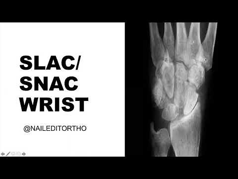 SLAC/SNAC Wrist w/ Dr. Rose