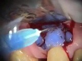 Root Resorption Repair • Video • MEDtube.net