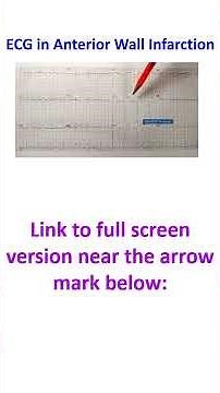 ECG in Anterior Wall Infarction