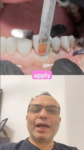 Composite Veneers 😁 Instant Smile Fix! #youtubeshorts #dentist #itdonline