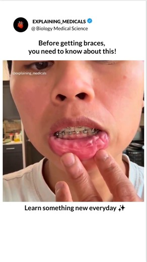 watch this before getting braces 😬 #Braces #DentalBraces #Orthodontics #OrthodonticTreatment #Teeth