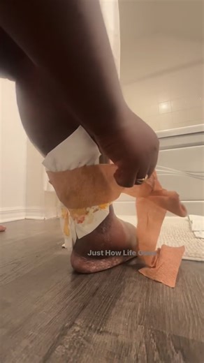 Destineé Spruell on Instagram: "Hidradenitis Suppurativa (HS) and PASH Syndrome aren’t “just skin issues.” They’re chronic, painful, lifelong inflammatory diseases that change everything about how we move, heal, and exist in our bodies. HS is a condition where the body creates abscesses, tunnels, cysts, and draining wounds deep under the skin — usually in places no one talks about: armpits, groin, belly button, under the breasts, thighs, behind the ears, and everywhere friction or sweat lives. I