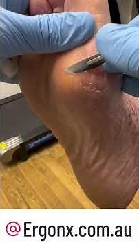 Eliminate Pinch Callus Pain Fast Expert Tips and Tricks to Soothe Hands #handcare #healthtips