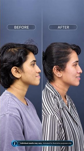 Orthognathic Jaw Surgery Before & After | Minimally Invasive Technique | Chengannur, Kerala