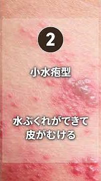 【夏に急増】水虫の症状・感染経路・治療法