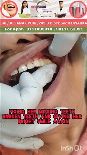 Missing Teeth replaced with Bridge #newteeth #dentist #dentalcare