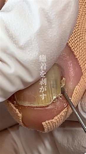 しづか｜足爪ケア専門｜千葉 on Instagram: "2ヶ月先を見込んだ施術⏱️ 伸びたらどうのるのか？ 常に計算しながら施術を行います🙇‍♀️ カットすればとか 角質除去すればとかの単純なものじゃなく 先を見越したケアでなければダメです🙅‍♀️ だからこそ当店の施術周期は 2〜3ヶ月おきが基本です🤝 ご予約お問い合わせはこちら @chiba_foot_shizuka618 【施術メニュー・その他情報ℹ️】 ______________________________ 【2026/１月〜改定後】 ◻︎ 初回フットケア ¥25,000- ◻︎ 2回目以降フットケア ¥20,000- ◻︎ トラブル施術追加１本 ¥3,000- ◻︎ 爪切りのみ ¥7,700- ◻︎ トラブルのみ１本 ¥12,000- ※ハンドメニューは常連様のみ 施術いただけます🙇‍♀️ ______________________________ スクール情報ℹ️ 【1/30〜2/7】🔗スクール説明会開催 スクール受け入れ枠(予定) 完全未経験(開業予定) 枠：1〜2名 開業済みフットケア経験者 枠：2〜