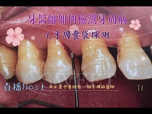 直播No.31 牙周囊袋探測
