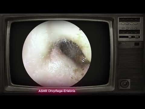 😴Deep Ear Wax Removal & Cleaning (Satisfying ASMR)