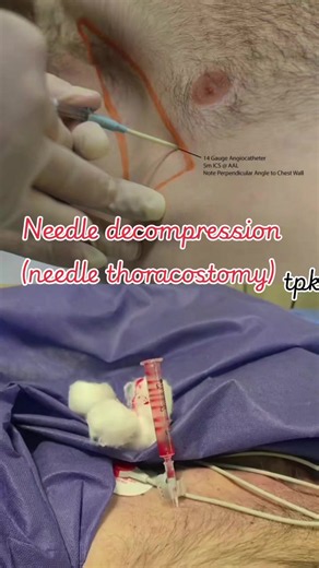 Needle decompression (needle thoracostomy) is an emergency, life-saving procedure used to treat a tension pneumothorax by releasing trapped, high-pressure air from the pleural space. It involves inserting a large-bore IV catheter into the chest wall, which immediately relieves compression on the heart and lungs before a permanent chest tube can be placed. Needle decompression and tube thoracostomy are emergency procedures used to treat a tension pneumothorax by releasing trapped air that presses