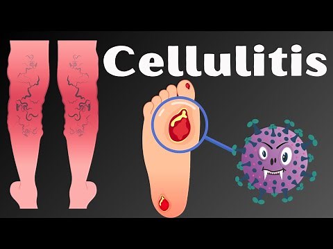 Cellulitis: Causes, Signs & Symptoms, Pathophysiology, Diagnosis, and Treatment