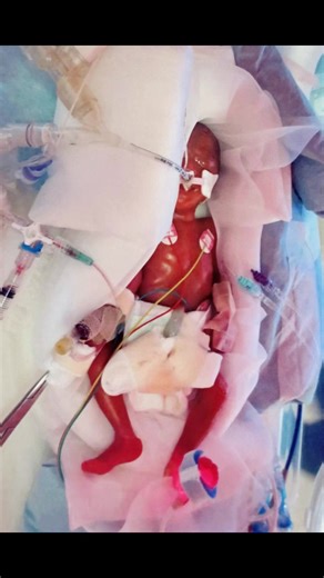 Miracle Premature Baby's Journey: Discharged After NICU Battle