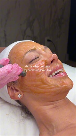 Understanding Collagen Regeneration Through Microneedling