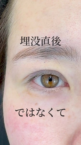 埋没直後ではなくて… 施術名二重整形 説明メスを使用して切開する切開法糸をまぶたに埋め込む埋没法 リスクだるさ熱感頭痛蕁麻疹痒みむくみ発熱目がゴロゴロする左右差があると感じる違和感 価格：9800～627400円 #埋#埋没経過二重切開