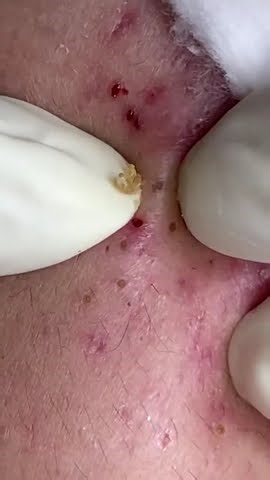 Big Cystic Acne Blackheads Extraction Blackheads & Milia, Whiteheads Removal Pimple Popping #shorts