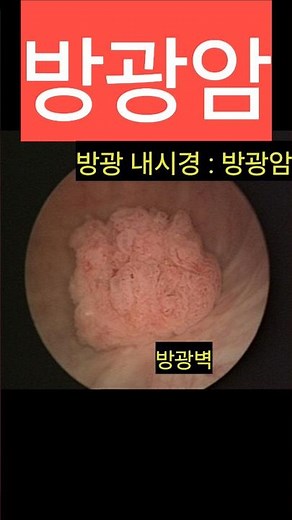 방광암 방광 초음파 내시경 진단 bladder cancer sonography cystoscopy