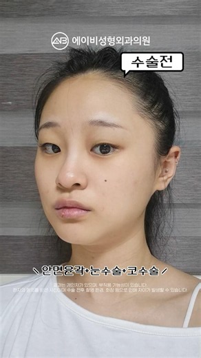 6-Month Before & After: Eyes + Nose + Facial Contouring #shorts