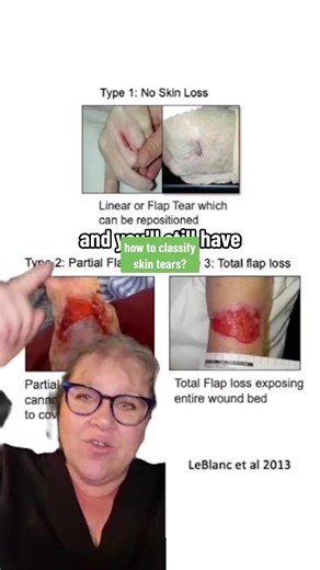 how to assess / classify skin tears to determine the level of damage ❤️‍🩹 #nurse #student #healthcare #skin #tear #dressing