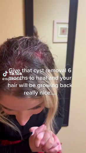Scalp Cyst Removal: Healing Process and Hair Growth Update