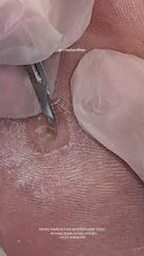 Suffering from a deep, painful corn? 😣