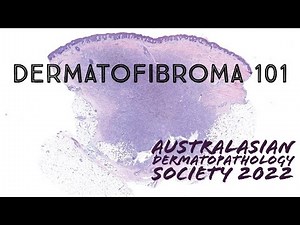 Dermatofibroma under the microscope (‪dermatology pathology dermpath USMLE)