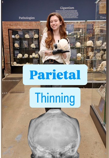 Understanding Thin Parietal Bones in Skulls