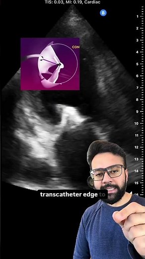 MitraClip - Trans-catheter Edge to Edge Repair