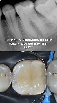Deep Margin Elevation Part I: Isolation, Caries Detection & Saddle Matrices Explained