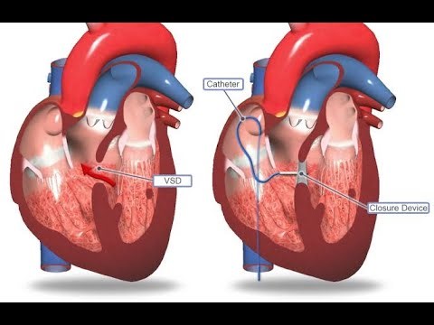 Direct suturing or use of patch Surgery for Ventricular Septal defect