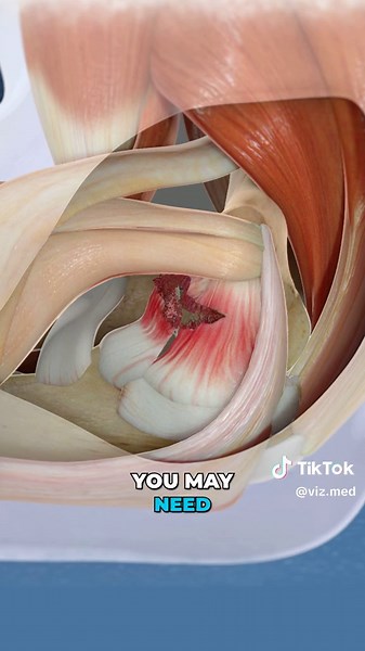 An ulnar collateral ligament (UCL) injury refers to damage to the ligament on the inner side of the elbow, which primarily stabilizes the joint during throwing motions. For severe UCL tears, surgery (commonly called