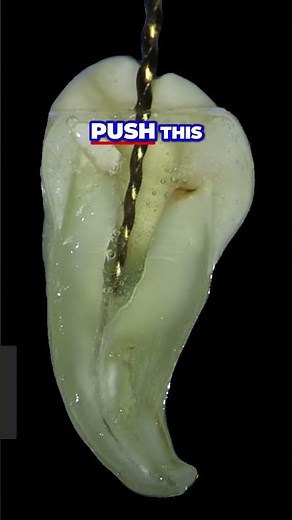 Mastering Rotary Files Navigating Deep Curved Canals