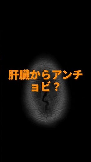 アンチョビが肝臓に【アメーバ性肝膿瘍】