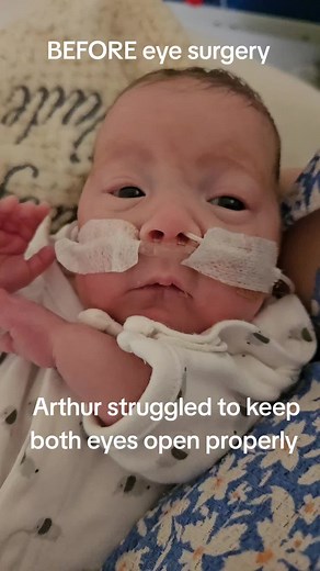 Here ye, Here ye! Before and After eye surgery to save Arthur's eye sight 💓 he was going blind and his retinas were detaching due to ROP. Today, we had the confirmation that HE CAN SEE! He has lost his peripheral vision, but he is not completely blind. . . . #lovelilyandarthur #preemie #premature #pregnancy #preemiesupportandawareness #pprom #preemiesize #baby #maternity #micropreemie #pvl #braindamage #viral #24weeks #miracle #nicujourney #niculife #nicumum #nicu #maternity #preemiesizeuk #pre