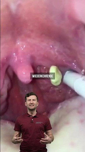 How to remove tonsil stones #shorts