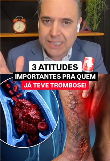 Inchaço, escurecimento da pele, dor e até feridas podem aparecer com o tempo se a perna não receber os cuidados certos. No vídeo eu mostro 3 atitudes importantes que podem ajudar a proteger sua perna no dia a dia. E lembre: cada caso é único. O tratamento precisa ser individualizado e acompanhado por um médico vascular. Me conta aqui nos comentários: você ainda sente algum sintoma depois da trombose? #dralexdornelles #vascular #trombose