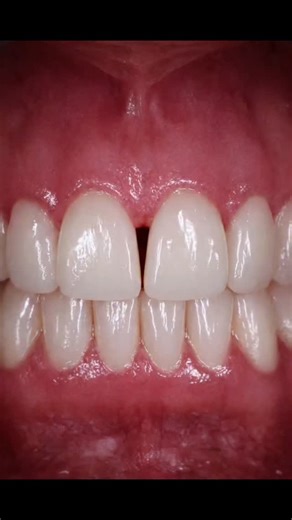 ARTISTA DENTAL HEALTH CARE | Midline diastema closure | Instagram