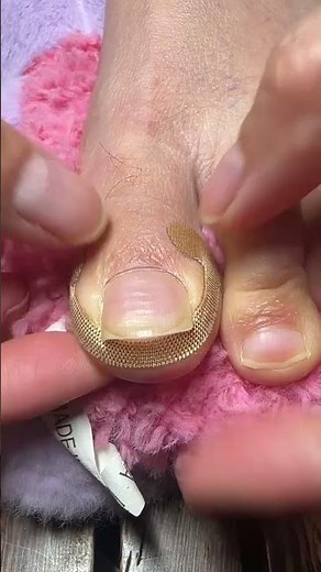 Ingrown Toenail Correction Tool 👣 | Safe Nail Lifting, Pain Relief & Fast Recovery