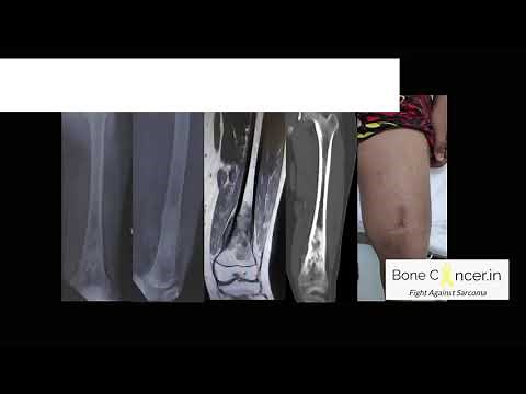 Bone Cancer (Osteosarcoma Femur): Limb Salvage Surgery-Tumor Megaprosthesis, Dr Srimanth B S