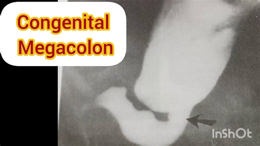 Congenital Megacolon/learn clinical anatomy