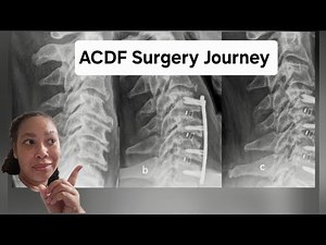 "My ACDF Surgery Journey | From Pain to Healing (C3–C6 Fusion Story)