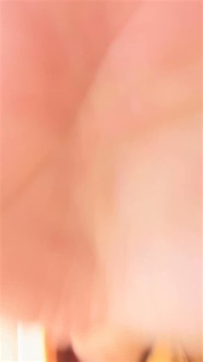 Stephanie Rogers | Doctor • Dreamer • Do-er on Instagram: "A new multicenter randomized trial evaluated gabapentin for pain management after major cardiac, thoracic, and abdominal surgery. Despite its routine inclusion in multimodal analgesia protocols, the results were clear: -No meaningful reduction in pain, opioid use, or length of stay. -Higher rates of pain at 4 weeks and 4 months in the gabapentin group. -Adverse events (sedation, respiratory depression, vomiting) occurred more often in th